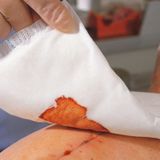 Hartmann - Zetuvit - steriel absorberende verband - 10 x 10cm