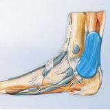 Novamed / Morsa Achiloberg achillespees brace - Rechts