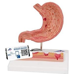 3B Scientific Menselijke anatomie - maagen met maagzweren + gratis anatomiesoftware - 3B Smart Anatomy