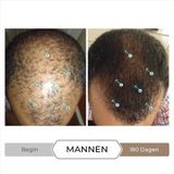 Spectral DNC-N met 5% Nanoxidil - (3 maanden voorraad)