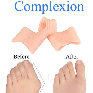 Grote Teen Overlap Siliconen Hallux Valgus Corrector Teenseparators Bunion Correctoren Voet Vinger Splitter Teen Bescherming Orthese