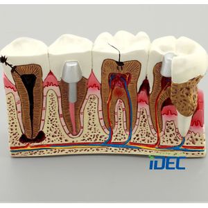 Dental Studie Onderwijs Model Cariës Anatomie Tandarts Communicatie Model 1 Pc