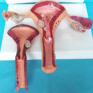 Vrouwelijke Pathologische Baarmoeder Model Geavanceerde Simulatie Pathologische Baarmoeder Model Van Structuur Anatomie Van Gynaecologie En Verloskunde