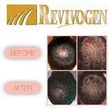 Revivogen - Scalp Therapy MD - Haargroeimiddel - 3 flessen van 60 ml - 3 maanden