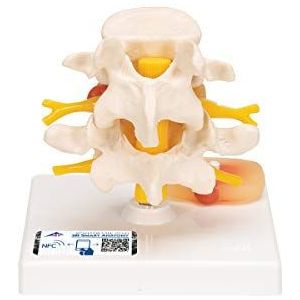 3B Scientific A76 lumbale wervels model met tussenwervelschijf prolaps + gratis anatomie-app - 3B Smart Anatomy