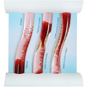 Lage dichtheid Lipoprotein LDL Bloedvat Model voor Medisch Patiënt Arts Onderwijs