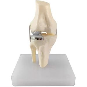 LKYLVEE Model met één condylus kniegewricht - Model voor totale knievervanging - Anatomisch leermiddel voor voorlichting en studie van patiënten,A,15cm