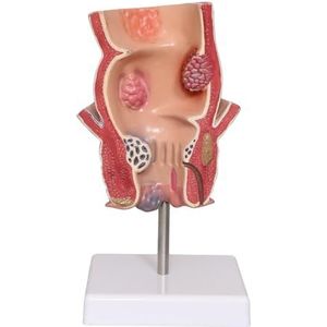 LKYLVEE Anorectaal Acne Pathologiemodel – Medisch Lesgeven Hemorroïden Pathologiemodel – Rectaal Intestinaal Anatomisch Model,A,14CM