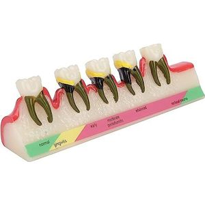 Teeth Teaching Model, Teeth Dental Demonstration Model, Dental Caries Teeth Model Dental Tooth Decay Model, Tooth Typodont Model For Dentist And Patients Communication