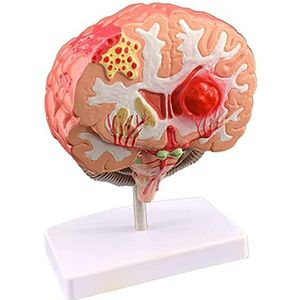 Pathologische Hersenstructuur Anatomie Model - Levensgrote Menselijk Hersenmodel - Educatief Model Hersenanatomisch Model - PVC Cerebrale Cortex Grijze Materie Zenuw