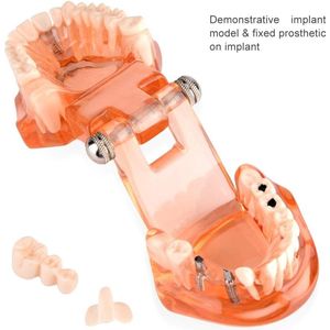 Dental model - verwijderbaar dental implant - demonstratiemodel - dental tool met verstelbare hoek 180° voor tandheelkundige school - studie - educatie