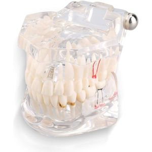 Fantoma Dental Model - Demonstratie van de Tanden - Verwijderbare Tanden voor Tandheelkundige Klassen - Mondzorg