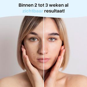 Dermastamp - 140 Naalden 0 tot 3mm - Dermaroller - Microneedling - Huidverzorging