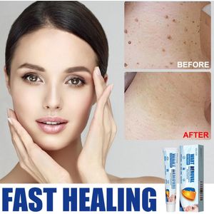 EELHOE Crème voor Huidlabel-verwijdering – Mild & Helder – Voor Gezicht, Handen & Voeten – Huidlabels, Huidherstel, Verlichter, Gezicht & Lichaam20g