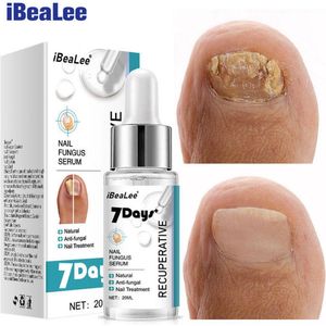 kalknagelbehandeling-schimmelnagel behandeling-behandeling voor kalknagels-schimmelnagels-verkleurde nagels-MET SALICSYLZUUR