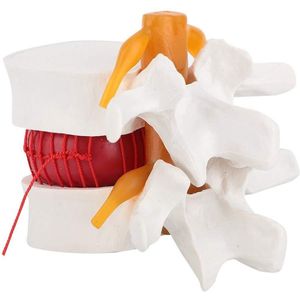 1.5X Medisch Demonstratiemodel van de Lumbale Wervelkolom – Hernia Model met Zachte Elastomeer Tussenwervelschijf, Lichtgewicht Leerhulpmiddel