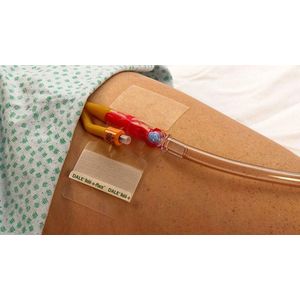 Dale - Katheter Fixatiepleister - Huidvriendelijk - Waterbestendig