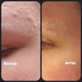 The Ordinary Salicylic Acid 2% Anhydrous Solution