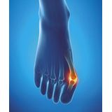 Epitact Hallux Valgus Beschermer