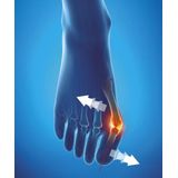 Epitact - Hallux Valgus Corrigerende Orthese - Nacht - Epitheliumflex - 1 Stuk