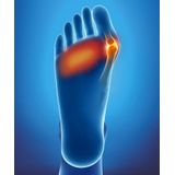 Epitact Hallux valgus - knobbel en Eelt - corrigerende orthese - Rechter voet - Large
