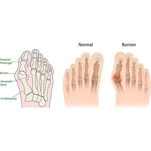 Hanwag - Belorado 2 Mid Bunion GTX - Wandelschoenen - Zwart - Gore-Tex