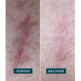 APRICOT - Littekenpads - 2 Stk - Medische Kwaliteit - Siliconen - Skincare