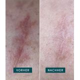 Apricot - Herbruikbare Littekenkompressen - Mini Siliconenpad - 4 stuks - Met Aloë Vera