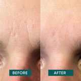 Apricot I Gezichtspleisters I 100 stuks I Hyaluron I Fronsrimpels