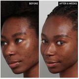 The Inkey List - Tranexamic Acid Serum - Huidverzorging - 30ml