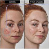 The INKEY List - SuperSolutions - Huidverzorging - 10% Azelaïnezuur