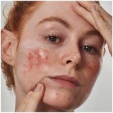 The INKEY List - SuperSolutions - Huidverzorging - 10% Azelaïnezuur