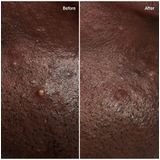 The INKEY List - Hydrocolloid Pimple Patches - Transparant - 10 Stuks