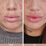 Australian Bodycare - Tea Tree Olie Stick - Tea Tree - 3 x 9 ml