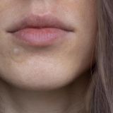 Pimple Patches - Effectieve Oplossingen voor een Zuivere Huid - Met Hyaluronzuur en Salicylzuur