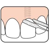 TePe Bridge & Implant floss – 30 st