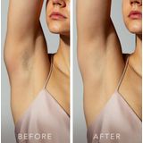 FOREO PEACH™ 2 - IPL-apparaat - Peach - Huidverzorging