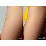 FOREO - PEACH™ 2 go - IPL-apparaat - Peach - Reisvriendelijk en Compact