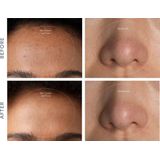 FOREO KIWI™ - Poriën Reiniger - Blauw LED-Licht - Diepe Reiniging