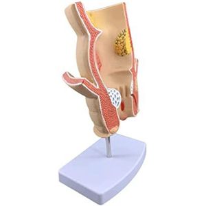 Anorectale Acne Pathologie Anatomisch Model Rectaal Pathologisch Model Medisch Onderwijs Aambeien Pathologie Model Orgaanmodel