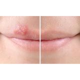 Sorefix - Duo Patch - Koortslip Patch - Transparant - 15 Actieve Patches