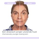 Derma Wand PRO Huidsverzorgingsapparaat Anti-aging Microdermabrasie - Huidsimulatie - Gezichtsmassage