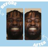 Smyle - Teeth Whitening Kit - Gebitsverzorging - Inhoud 10 Sessies - Plasticvrij