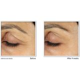 RoC - Retinol Correxion - Oogcrème - 15 ml - 3x Verpakking